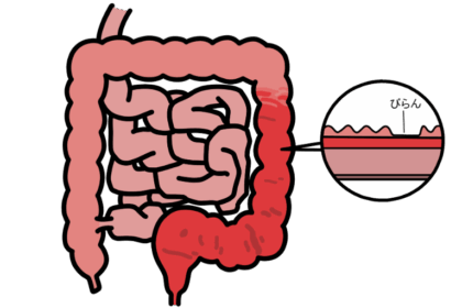 大腸のみで炎症が起こる潰瘍性大腸炎