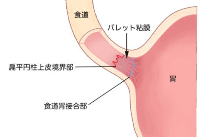 逆流性食道炎・バレット食道を放置すると癌になる？