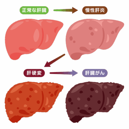 40～50代から罹患率が高くなる肝癌