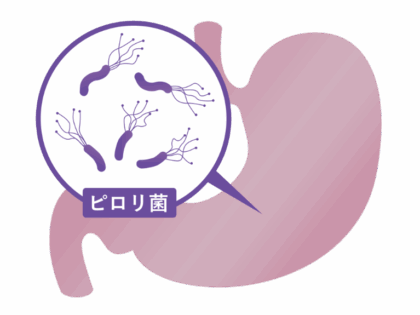 萎縮性胃炎とピロリ菌の関係
