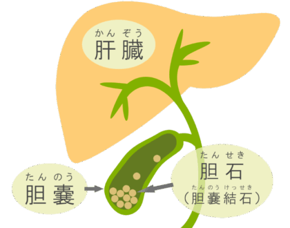 食生活の欧米化などにより増加している胆石症