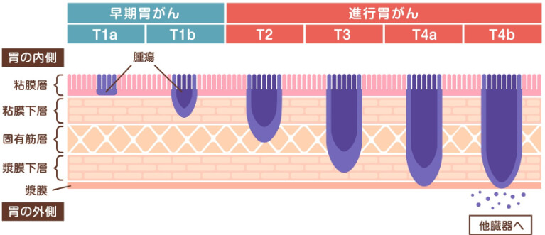 胃がんのステージ