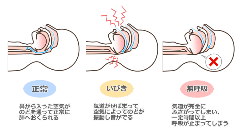 睡眠時無呼吸症候群（SAS）とは