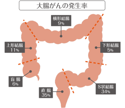 日本人の罹患者数・死亡者数とも多い大腸がん