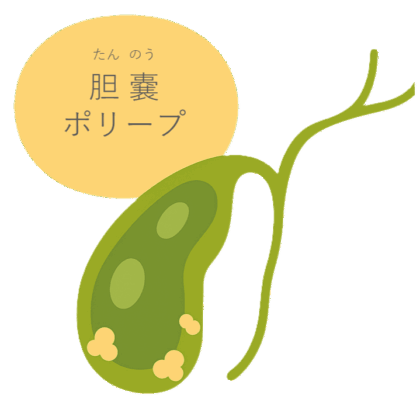 がん化のおそれもある胆嚢ポリープ